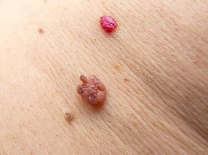 eruptive cherry angiomas utilizing ionized carbonation technology
