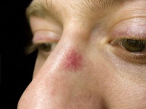 remove cherry angiomas