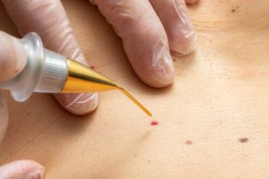 simple skin tag skin tags