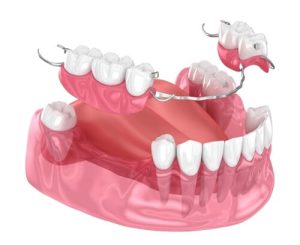 lower partial denture